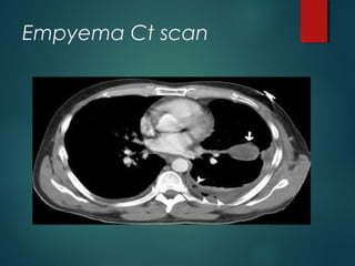 Empyema Ct scan
 