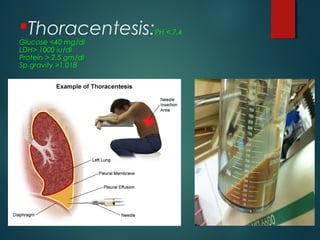 Thoracentesis:PH < 7.4
Glucose <40 mg/dl
LDH> 1000 iu/dl
Protein > 2.5 gm/dl
Sp.gravity >1.018
 