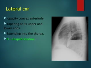 Lateral cxr
 opacity convex anteriorly.
Tapering at its upper and
lower ends
Extending into the thorax.
D – shaped shadow.
 