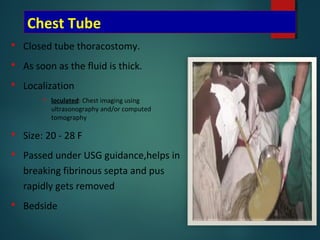 Chest Tube
 Closed tube thoracostomy.
 As soon as the fluid is thick.
 Localization
 loculated: Chest imaging using
ultrasonography and/or computed
tomography
 Size: 20 - 28 F
 Passed under USG guidance,helps in
breaking fibrinous septa and pus
rapidly gets removed
 Bedside
 