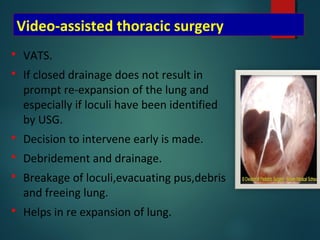 Video-assisted thoracic surgery
 VATS.
 If closed drainage does not result in
prompt re-expansion of the lung and
especially if loculi have been identified
by USG.
 Decision to intervene early is made.
 Debridement and drainage.
 Breakage of loculi,evacuating pus,debris
and freeing lung.
 Helps in re expansion of lung.
 