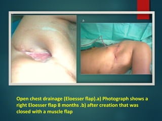 Open chest drainage (Eloesser flap).a) Photograph shows a
right Eloesser flap 8 months .b) after creation that was
closed with a muscle flap
 