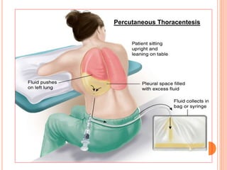 Percutaneous Thoracentesis
 