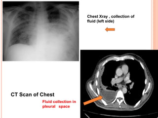CT Scan of Chest
Fluid collection in
pleural space
Chest Xray , collection of
fluid (left side)
 