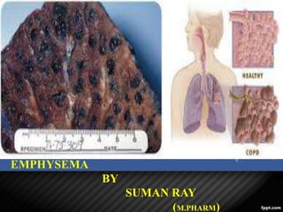 Presentation Title
EMPHYSEMA
BY
SUMAN RAY
(M.PHARM)
 