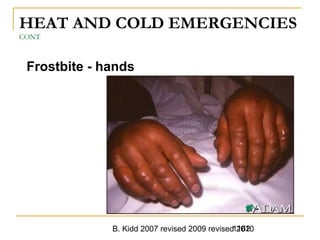 B. Kidd 2007 revised 2009 revised 20101162
HEAT AND COLD EMERGENCIES
CONT
Frostbite - hands
 