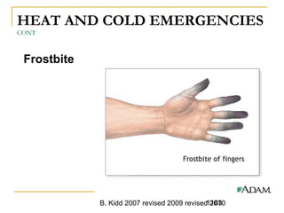 B. Kidd 2007 revised 2009 revised 20101163
HEAT AND COLD EMERGENCIES
CONT
Frostbite
 