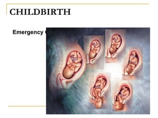 B. Kidd 2007 revised 2009 revised 20101322
CHILDBIRTH
Emergency Childbirth
 
