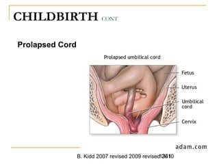 B. Kidd 2007 revised 2009 revised 20101341
CHILDBIRTH CONT
Prolapsed Cord
 