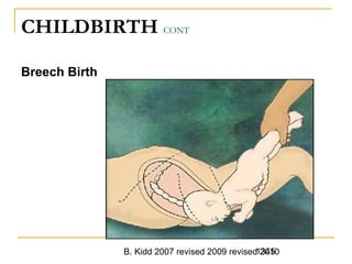 B. Kidd 2007 revised 2009 revised 20101345
CHILDBIRTH CONT
Breech Birth
 