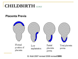 B. Kidd 2007 revised 2009 revised 20101395
CHILDBIRTH CONT
Placenta Previa
 