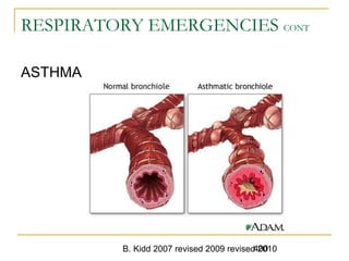 B. Kidd 2007 revised 2009 revised 2010400
RESPIRATORY EMERGENCIES CONT
ASTHMA
 
