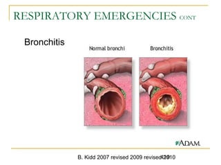 B. Kidd 2007 revised 2009 revised 2010419
RESPIRATORY EMERGENCIES CONT
Bronchitis
 
