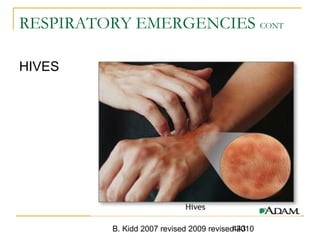B. Kidd 2007 revised 2009 revised 2010443
RESPIRATORY EMERGENCIES CONT
HIVES
 