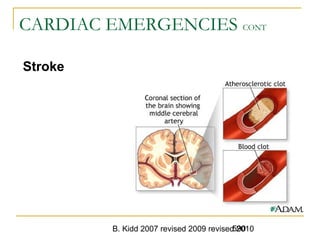 B. Kidd 2007 revised 2009 revised 2010590
CARDIAC EMERGENCIES CONT
Stroke
 