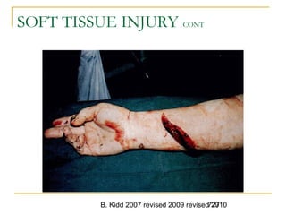 B. Kidd 2007 revised 2009 revised 2010727
SOFT TISSUE INJURY CONT
 