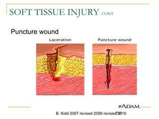 B. Kidd 2007 revised 2009 revised 2010731
SOFT TISSUE INJURY CONT
Puncture wound
 