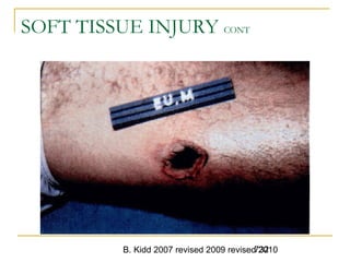 B. Kidd 2007 revised 2009 revised 2010732
SOFT TISSUE INJURY CONT
 