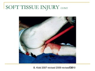 B. Kidd 2007 revised 2009 revised 2010733
SOFT TISSUE INJURY CONT
 