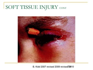 B. Kidd 2007 revised 2009 revised 2010734
SOFT TISSUE INJURY CONT
 