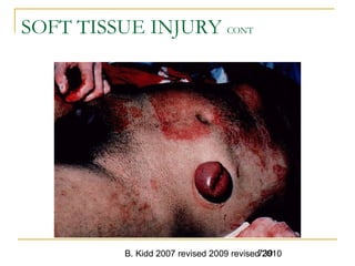 B. Kidd 2007 revised 2009 revised 2010739
SOFT TISSUE INJURY CONT
 