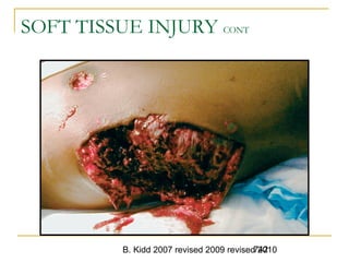 B. Kidd 2007 revised 2009 revised 2010742
SOFT TISSUE INJURY CONT
 