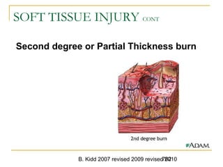 B. Kidd 2007 revised 2009 revised 2010762
SOFT TISSUE INJURY CONT
Second degree or Partial Thickness burn
 