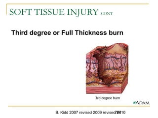 B. Kidd 2007 revised 2009 revised 2010764
SOFT TISSUE INJURY CONT
Third degree or Full Thickness burn
 