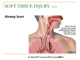 B. Kidd 2007 revised 2009 revised 2010768
SOFT TISSUE INJURY CONT
Airway burn
 