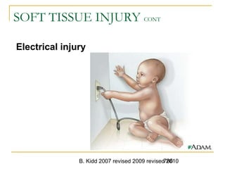 B. Kidd 2007 revised 2009 revised 2010786
SOFT TISSUE INJURY CONT
Electrical injury
 