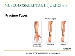 B. Kidd 2007 revised 2009 revised 2010853
MUSCULOSKELETAL INJURIES CONT
Fracture Types
 