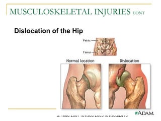 B. Kidd 2007 revised 2009 revised 2010867
MUSCULOSKELETAL INJURIES CONT
Dislocation of the Hip
 