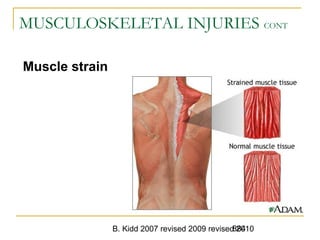 B. Kidd 2007 revised 2009 revised 2010884
MUSCULOSKELETAL INJURIES CONT
Muscle strain
 