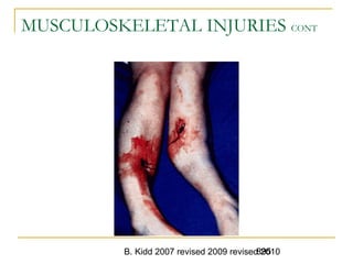 B. Kidd 2007 revised 2009 revised 2010895
MUSCULOSKELETAL INJURIES CONT
 