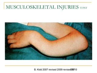 B. Kidd 2007 revised 2009 revised 2010897
MUSCULOSKELETAL INJURIES CONT
 