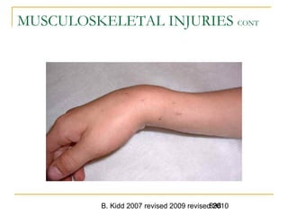 B. Kidd 2007 revised 2009 revised 2010898
MUSCULOSKELETAL INJURIES CONT
 