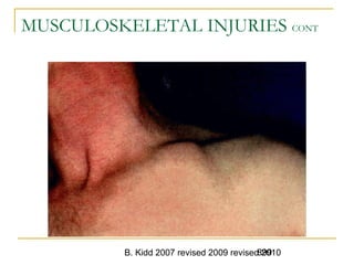 B. Kidd 2007 revised 2009 revised 2010899
MUSCULOSKELETAL INJURIES CONT
 