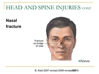 B. Kidd 2007 revised 2009 revised 2010949
HEAD AND SPINE INJURIES CONT
Nasal
fracture
 