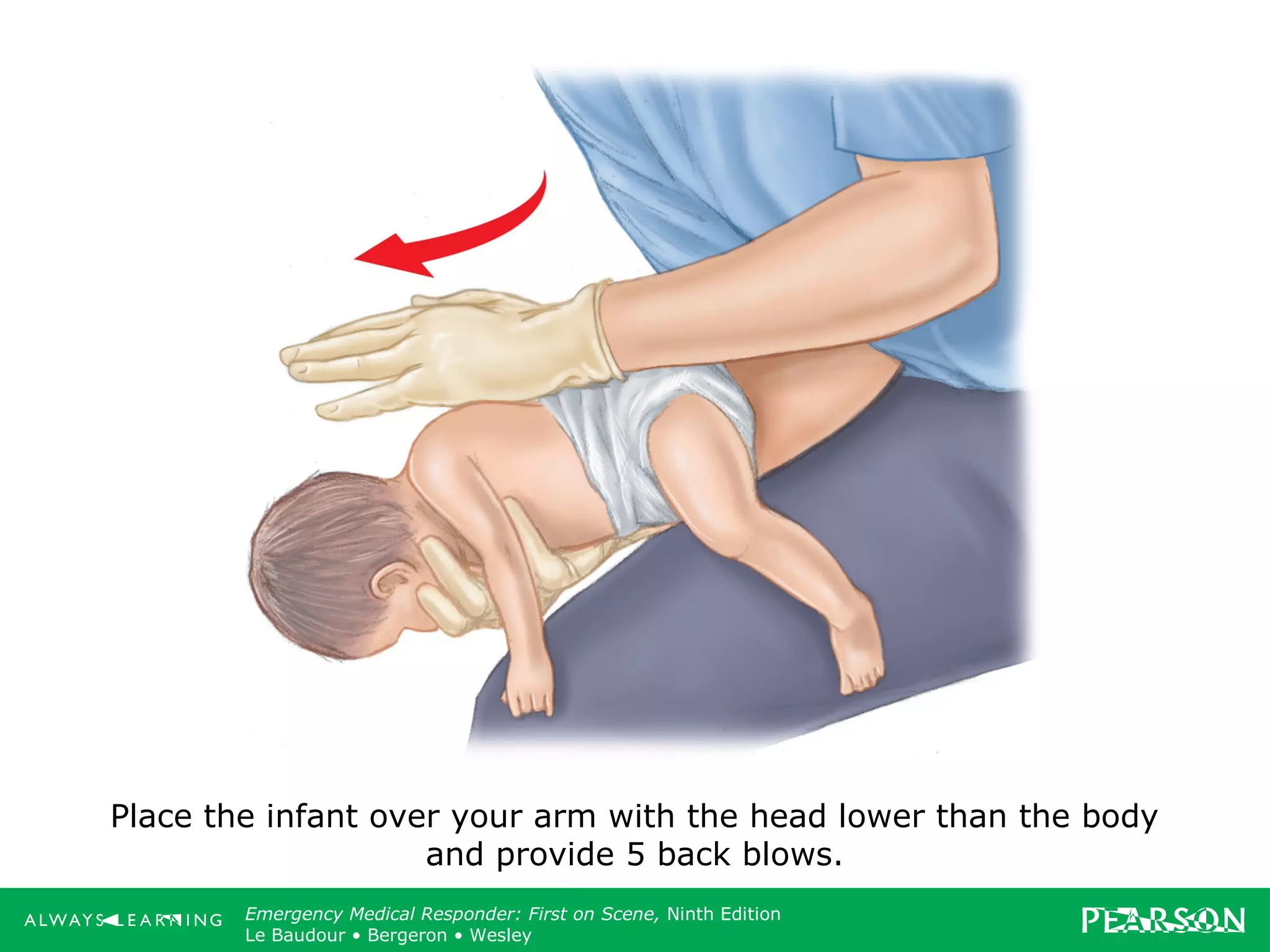 Copyright ©2012 by Pearson Education, Inc.
All rights reserved.
Emergency Care, Twelfth Edition
Daniel J. Limmer • O’Keefe • Grant • Murray • Bergeron • Dickinson
Emergency Medical Responder: First on Scene, Ninth Edition
Le Baudour • Bergeron • Wesley
Place the infant over your arm with the head lower than the body
and provide 5 back blows.
 