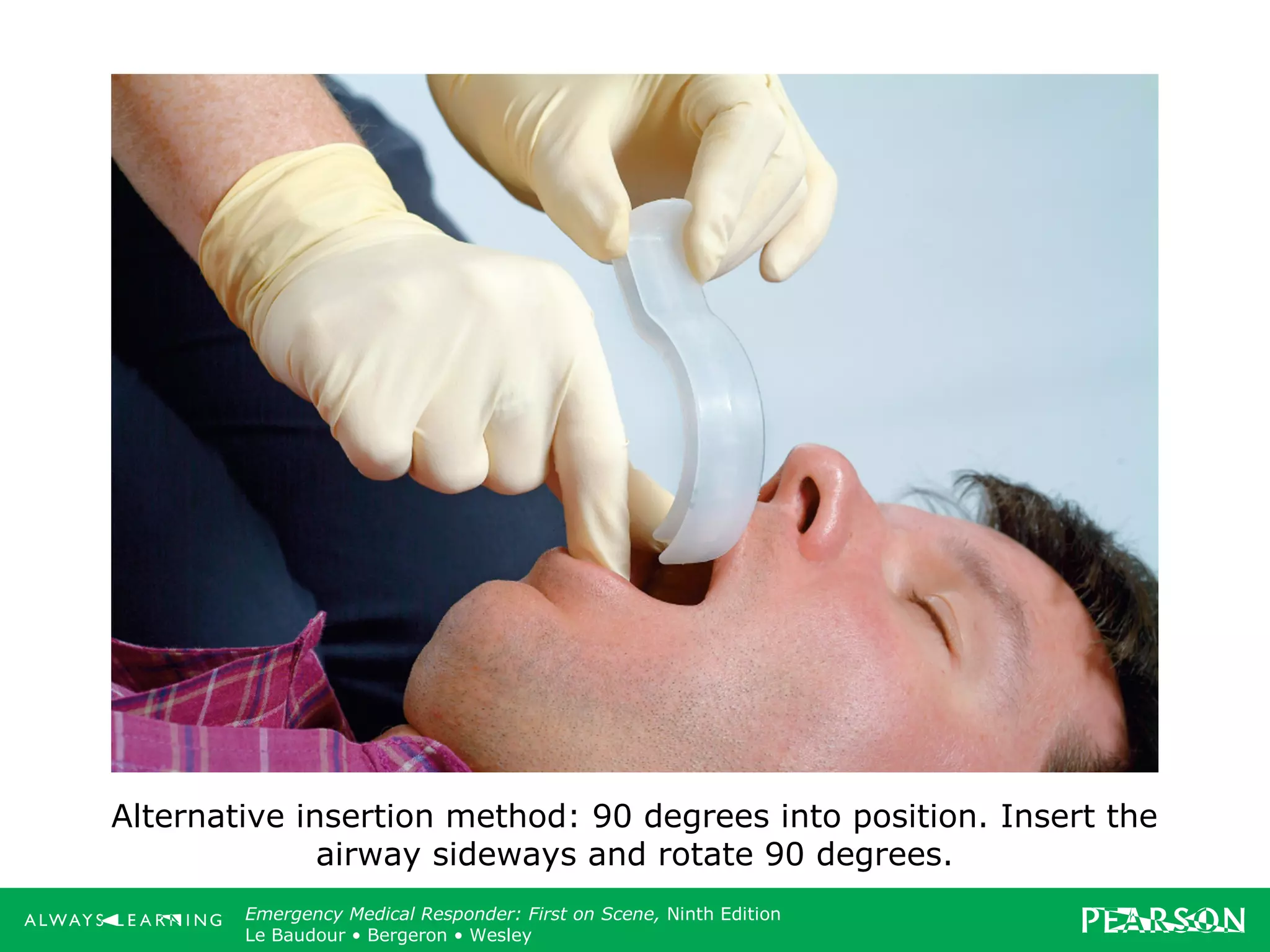 Copyright ©2012 by Pearson Education, Inc.
All rights reserved.
Emergency Care, Twelfth Edition
Daniel J. Limmer • O’Keefe • Grant • Murray • Bergeron • Dickinson
Emergency Medical Responder: First on Scene, Ninth Edition
Le Baudour • Bergeron • Wesley
Alternative insertion method: 90 degrees into position. Insert the
airway sideways and rotate 90 degrees.
 