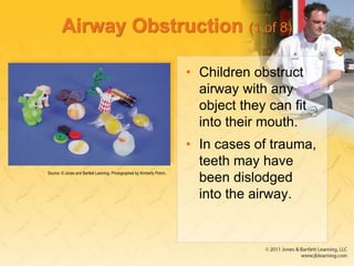 Airway Obstruction (1 of 8)
• Children obstruct
airway with any
object they can fit
into their mouth.
• In cases of trauma,
teeth may have
been dislodged
into the airway.
Source: © Jones and Bartlett Learning. Photographed by Kimberly Potvin.
 