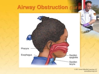 Airway Obstruction (3 of 8)
 