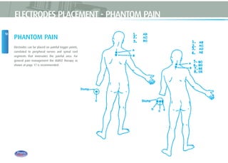 18
PHANTOM PAIN
Electrodes can be placed on painful trigger points,
correlated to peripheral nerves and spinal cord
segments that innervates the painful area. For
general pain management the BURST therapy as
shown at page 17 is recommended.
ELECTRODES PLACEMENT - PHANTOM PAIN
 