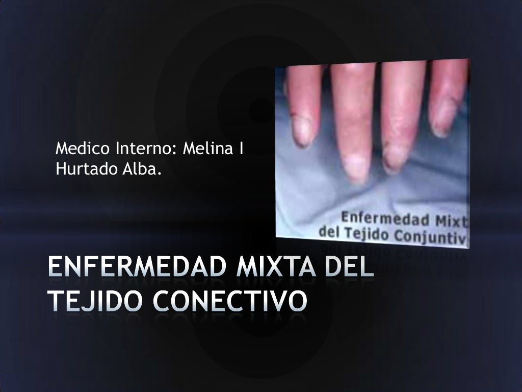 Enfermedad Mixta Del Tejido Conectivo Enfermedad Mixta Del Tejido Conectivo