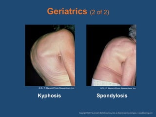 Geriatrics (2 of 2)
Kyphosis Spondylosis
© Dr. P. Marazzi/Photo Researchers, Inc. © Dr. P. Marazzi/Photo Researchers, Inc.
 