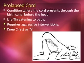 Condition where the cord presents through the
birth canal before the head.
Life Threatening to baby.
Requires aggressive interventions.
Knee Chest or ??
 