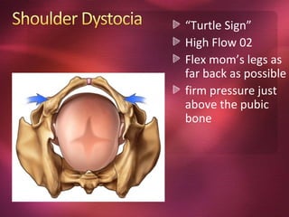 “Turtle Sign”
High Flow 02
Flex mom’s legs as
far back as possible
firm pressure just
above the pubic
bone
 
