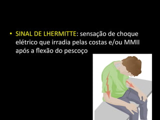 • SINAL	
  DE	
  LHERMITTE:	
  sensação	
  de	
  choque	
  
elétrico	
  que	
  irradia	
  pelas	
  costas	
  e/ou	
  MMII	
  
após	
  a	
  ﬂexão	
  do	
  pescoço	
  
 