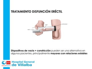 TRATAMIENTO DISFUNCIÓN ERÉCTIL
Dispositivos de vacio + constricción pueden ser una alternativa en
algunos pacientes, principalmente mayores con relaciones estables
 
