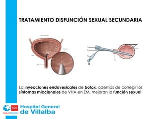 TRATAMIENTO DISFUNCIÓN SEXUAL SECUNDARIA
La inyecciones endovesicales de botox, además de corregir los
síntomas miccionales de VHA en EM, mejoran la función sexual
 